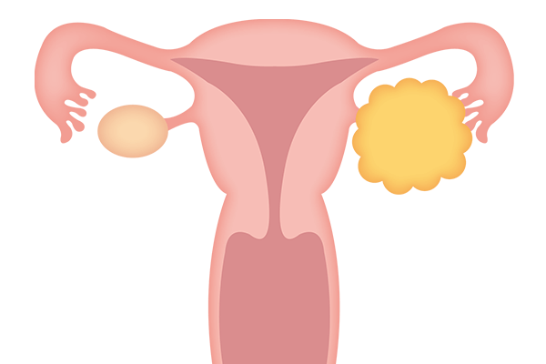 卵巣腫瘍とは