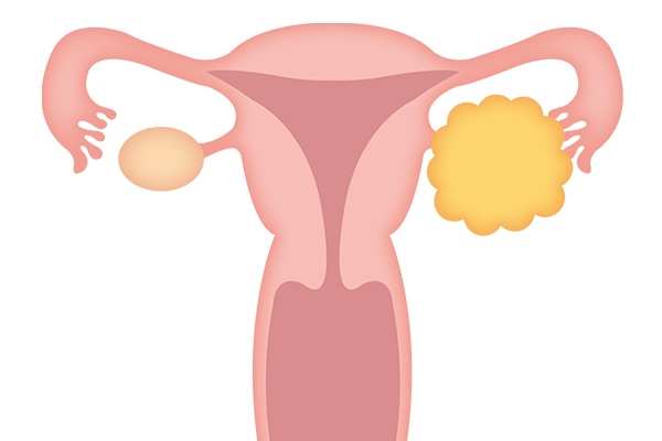 卵巣がんは胎児に影響を及ぼしますか?